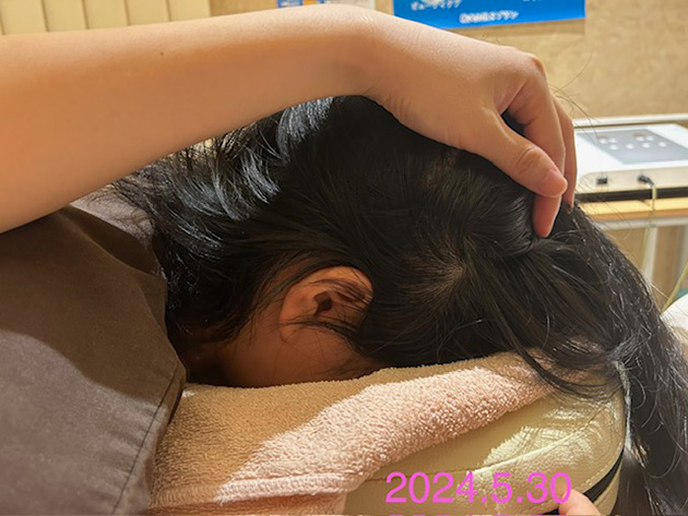 20代女性、円形脱毛症における鍼灸治療の事例1