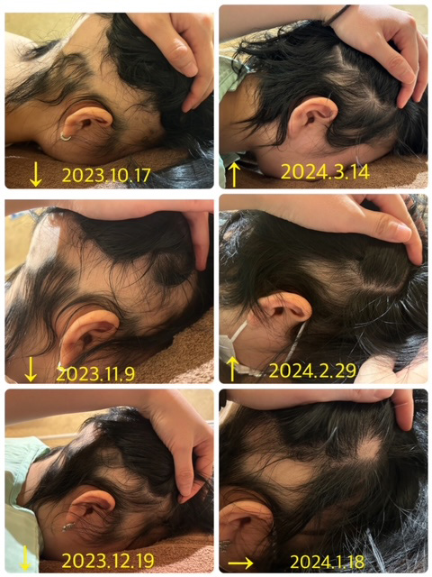 20代女性、円形脱毛症における鍼灸治療の事例 (経過写真1)