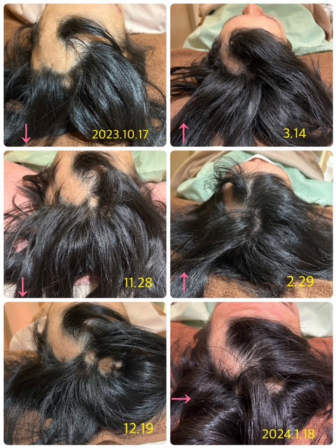 20代女性、円形脱毛症における鍼灸治療の事例 (経過写真2)