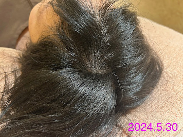 20代女性、円形脱毛症における鍼灸治療の事例2