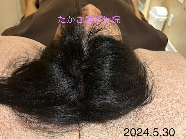 20代女性、円形脱毛症における鍼灸治療の事例3