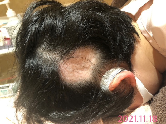 円形脱毛症における鍼灸治療の事例1