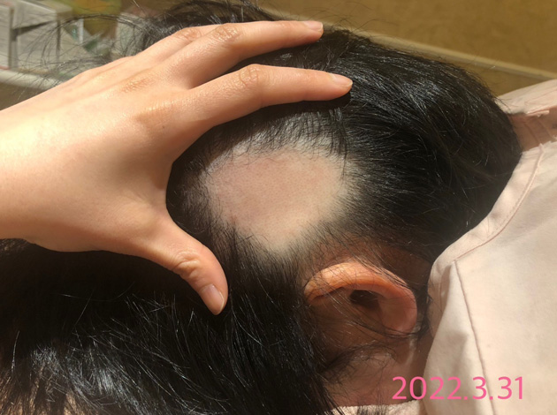 円形脱毛症における鍼灸治療の事例2