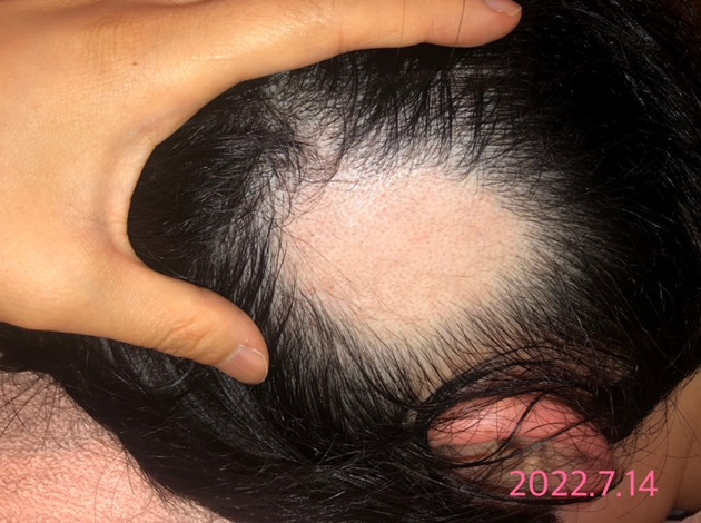 円形脱毛症における鍼灸治療の事例3