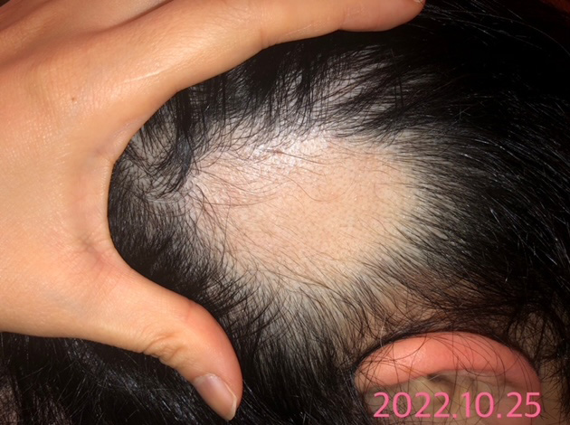 円形脱毛症における鍼灸治療の事例4