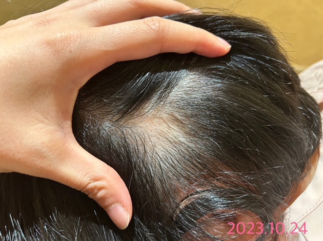 円形脱毛症における鍼灸治療の事例5