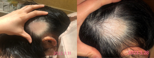 円形脱毛症における鍼灸治療のビフォーアフター