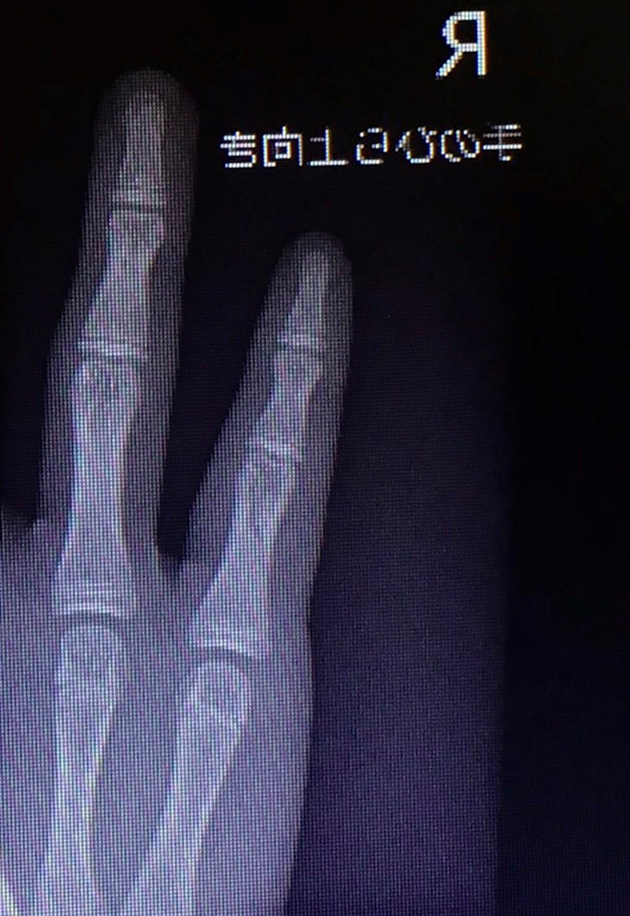 右手指第５基節骨不全骨折(亀裂骨折)の症例