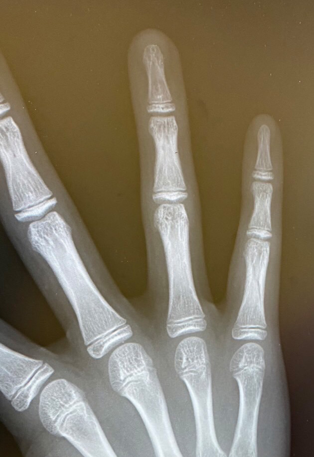 右手指第５基節骨不全骨折(亀裂骨折)治療開始から10日後のレントゲン写真。腫れが引き、骨癒合良好。