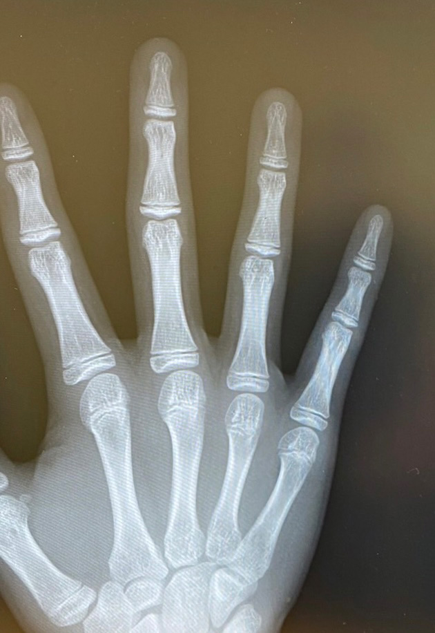 右手指第５基節骨不全骨折(亀裂骨折)治療から20日後に完治したレントゲン写真。